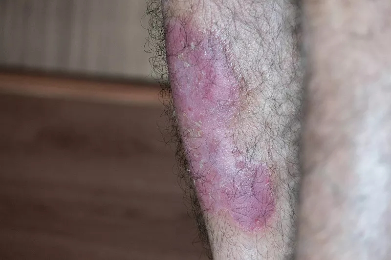 間充質干細胞成功治療斑塊狀銀屑病：案例研究