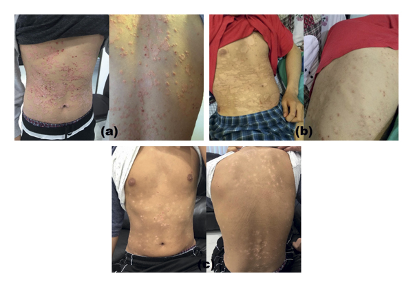 G-MSC輸注對一名有5年嚴重斑塊狀銀屑病病史的19歲男性的影響。