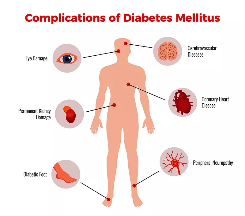 間充質(zhì)干細(xì)胞在治療糖尿病及并發(fā)癥的臨床應(yīng)用潛力 間充質(zhì)干細(xì)胞在治療糖尿病及并發(fā)癥的臨床應(yīng)用潛力