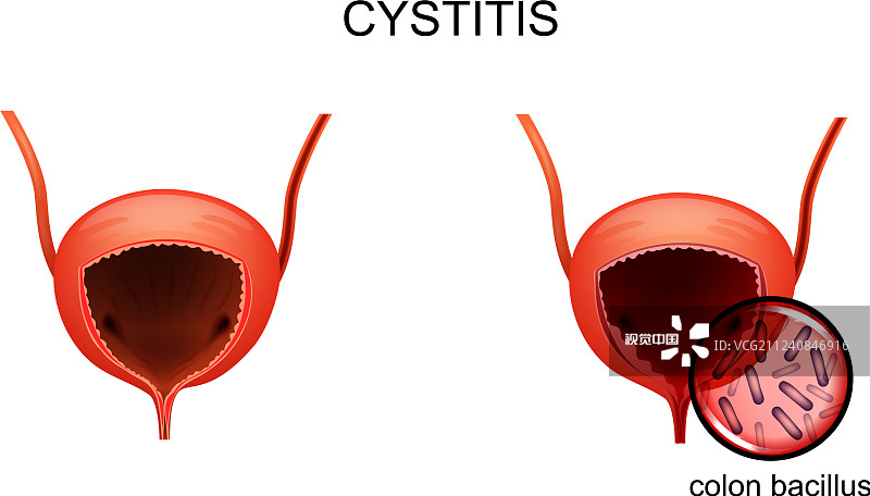 韓國(guó)首爾醫(yī)院公布:干細(xì)胞治療間質(zhì)性膀胱炎的I期研究結(jié)果 韓國(guó)首爾醫(yī)院公布:干細(xì)胞治療間質(zhì)性膀胱炎的I期研究結(jié)果