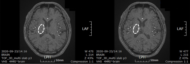 圖4：微創人臍帶間充質干細胞移植后患者的腦部計算機斷層掃描圖像。