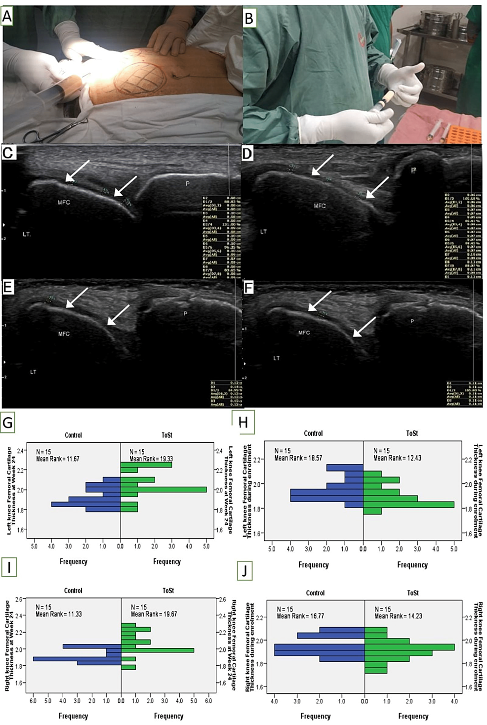圖1:TSC制備步驟和干預前后的軟骨厚度測量