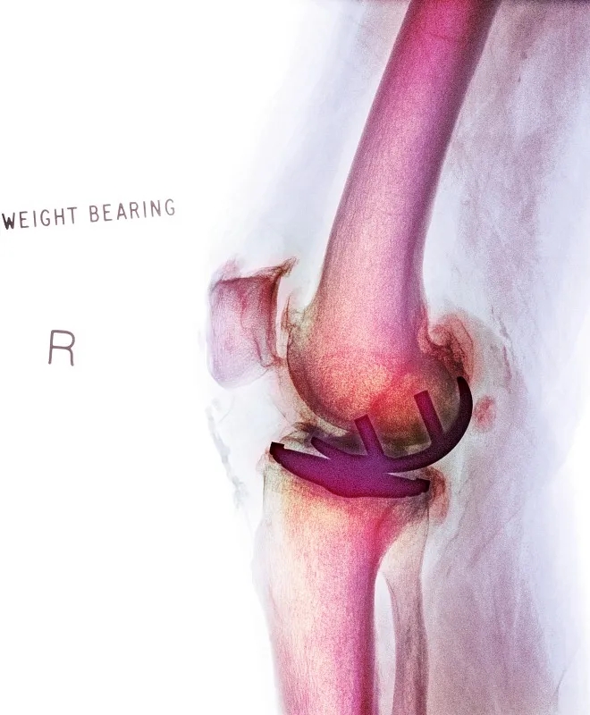 關節內移植干細胞治療膝骨關節炎:一項IIb期臨床試驗