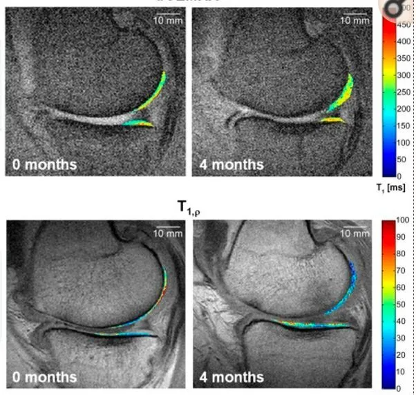 干細胞療法修復后疼痛顯著減輕，半月板軟骨質量提高。