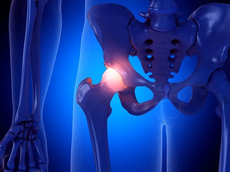 西班牙薩拉曼卡醫(yī)院:干細胞治療股骨頭壞死I/II期臨床試驗的長期結(jié)果