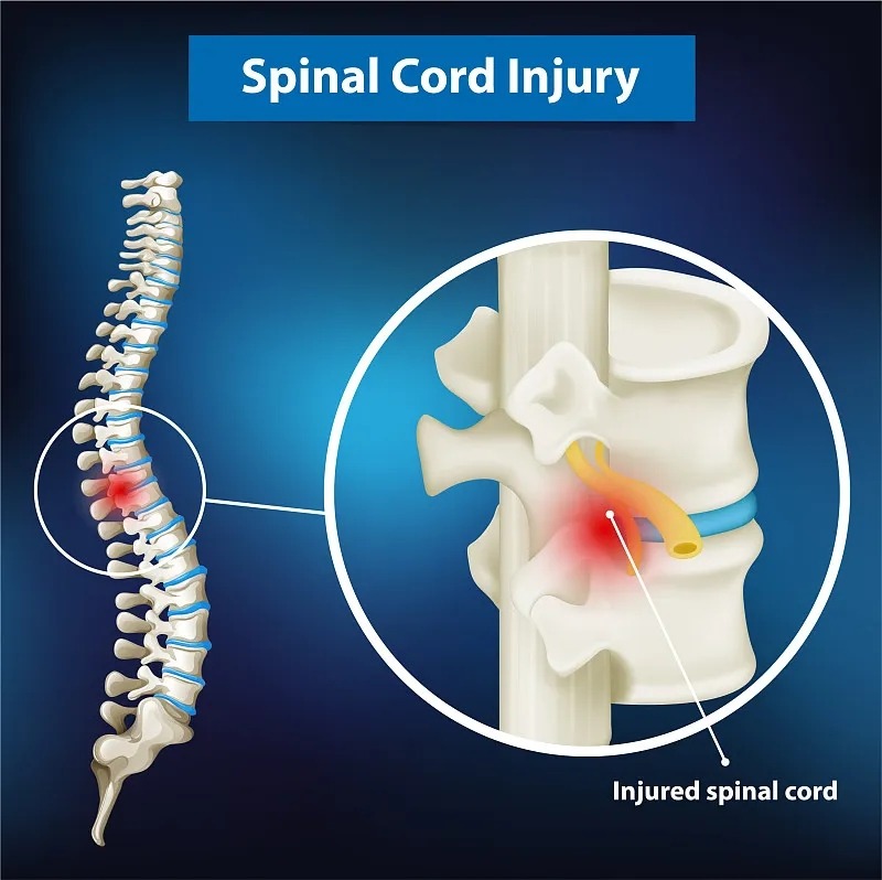 國家神經(jīng)疾病研究所:脊髓損傷的詳細(xì)信息