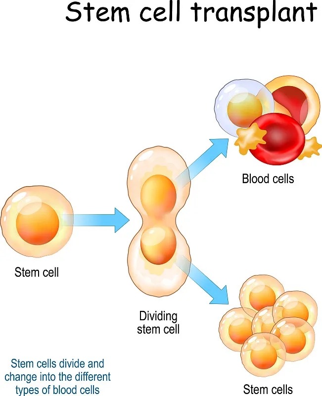干細胞移植的流程分為那五個階段