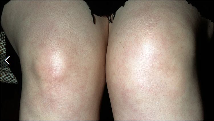 類風濕關節炎癥狀