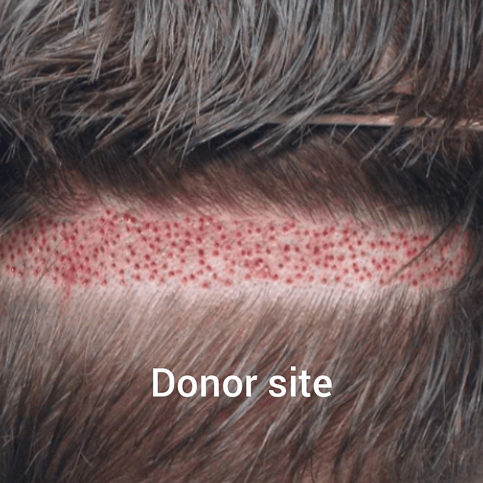 新技術(shù)的供體現(xiàn)場(chǎng)收獲試圖減少后部頭皮疤痕 新技術(shù)的供體現(xiàn)場(chǎng)收獲試圖減少后部頭皮疤痕