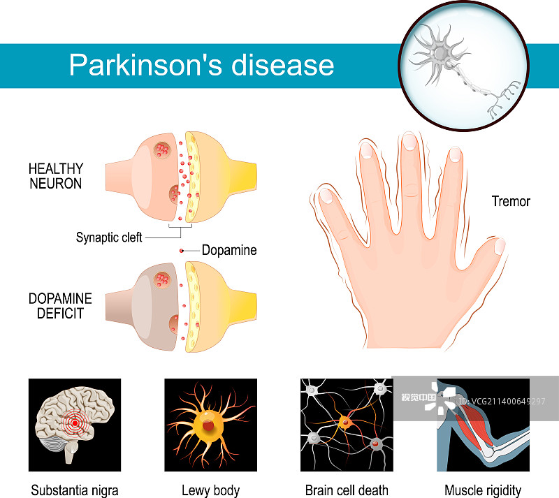 帕金森病的信息圖癥狀 帕金森病的信息圖癥狀