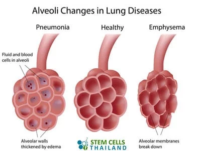 肺泡再生干細胞肺氣腫再生 肺泡再生干細胞肺氣腫再生