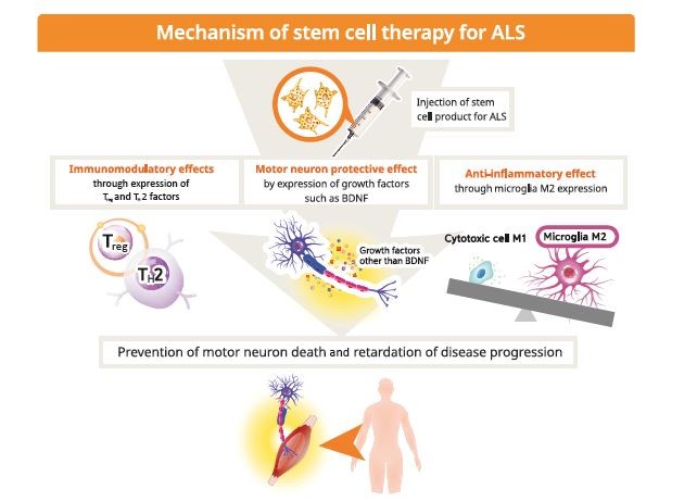 干細胞療法用于治療肌萎縮側索硬化癥（ALS）。