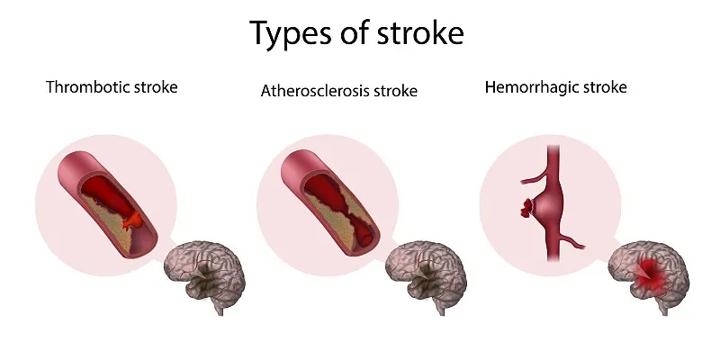 系統評估干細胞療法治療缺血性中風的安全性及可行性 系統評估干細胞療法治療缺血性中風的安全性及可行性