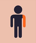 單癱型腦癱影響一側肢體,通常是手臂。 單癱型腦癱影響一側肢體,通常是手臂。