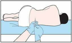 鞘內給藥 鞘內給藥