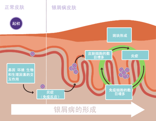 銀屑病治愈：是科學事實還是虛假希望？