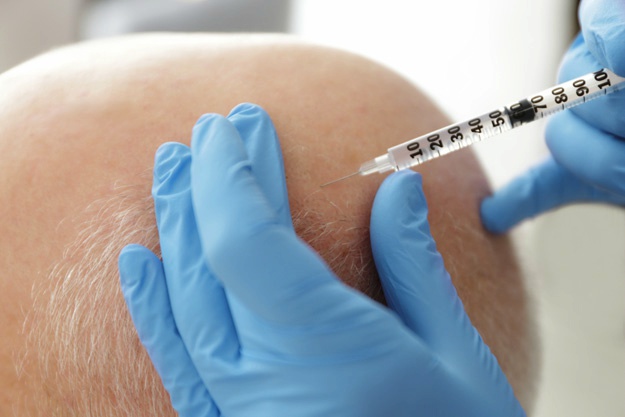 頭發修復過程是怎樣的? | 干細胞治療脫發 頭發修復過程是怎樣的? | 干細胞治療脫發