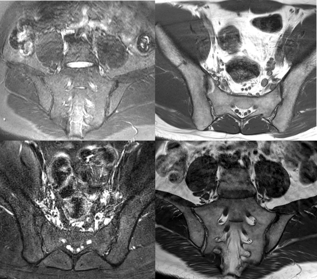 強直性脊柱炎是遺傳病嗎? 強直性脊柱炎是遺傳病嗎?