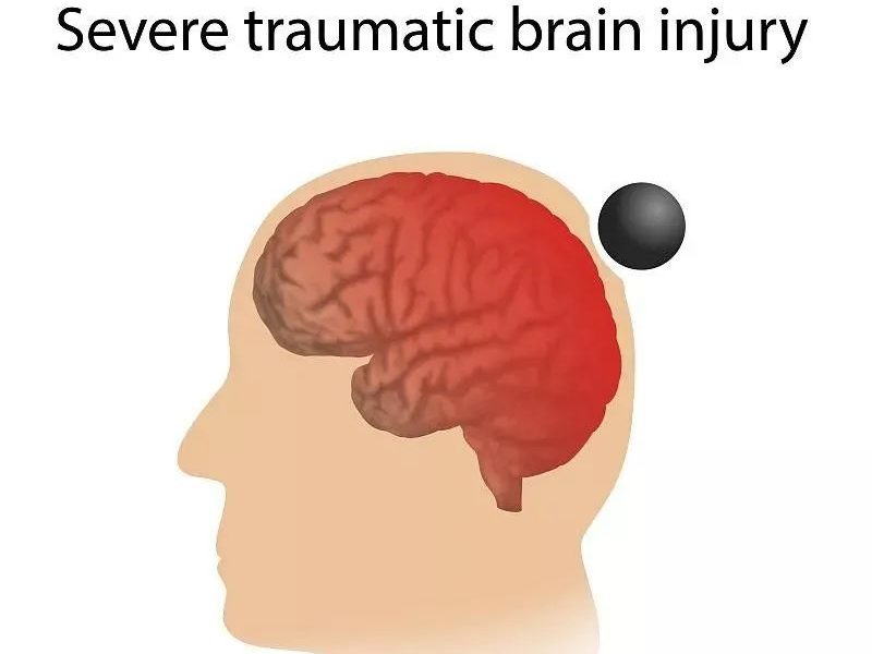 干細(xì)胞移植為缺血性腦損傷的治愈提供無(wú)限可能 干細(xì)胞移植為缺血性腦損傷的治愈提供無(wú)限可能