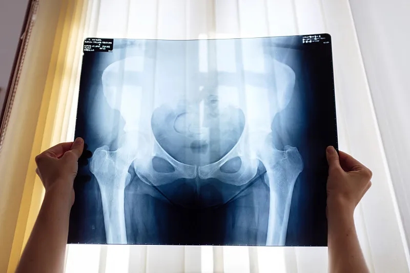 干細胞治療股骨頭缺血性壞死的臨床療效研究