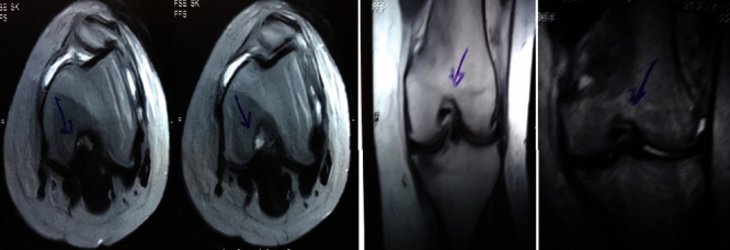 圖1：治療前MRI顯示內(nèi)側(cè)和外側(cè)半月板后角的III級(jí)撕裂。