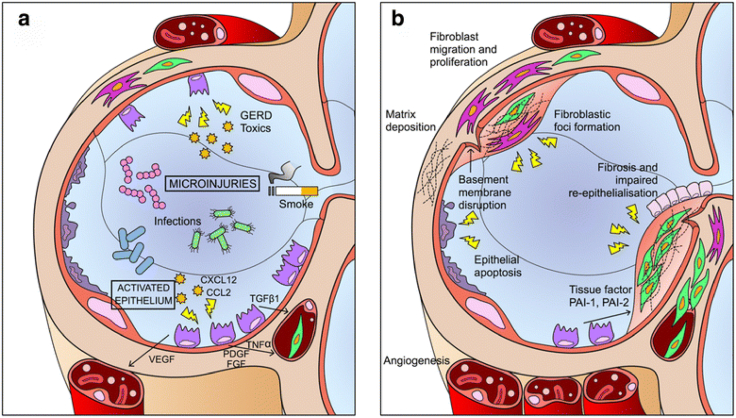圖1：IPF發病機制示意圖