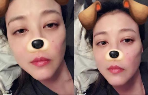 △ 周海媚之前發(fā)布的自拍照中也隱約可見面部紅斑 △ 周海媚之前發(fā)布的自拍照中也隱約可見面部紅斑