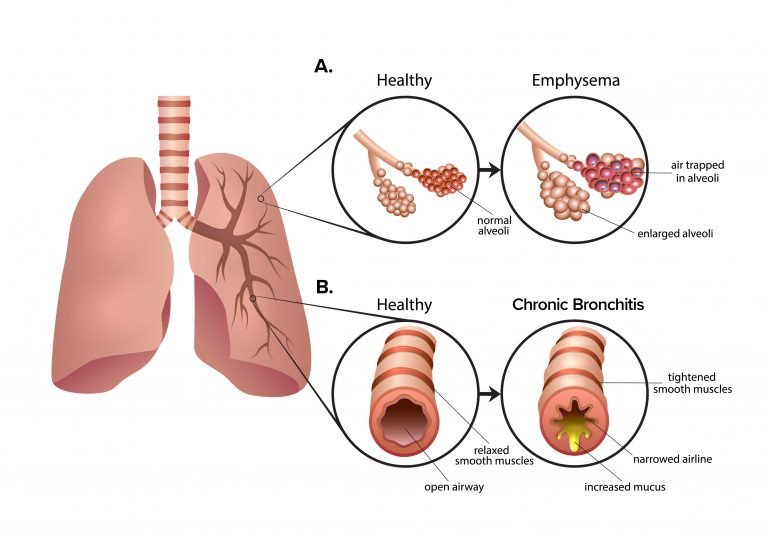 圖2：慢性阻塞性肺疾病 (COPD) 是一組導致呼吸困難的肺部疾病。A.肺氣腫導致肺泡氣囊受損和僵硬。空氣被困在肺泡中，導致呼氣困難。B.慢性支氣管炎會導致氣道腫脹和粘液增多。多余的粘液使呼吸困難并導致慢性咳嗽