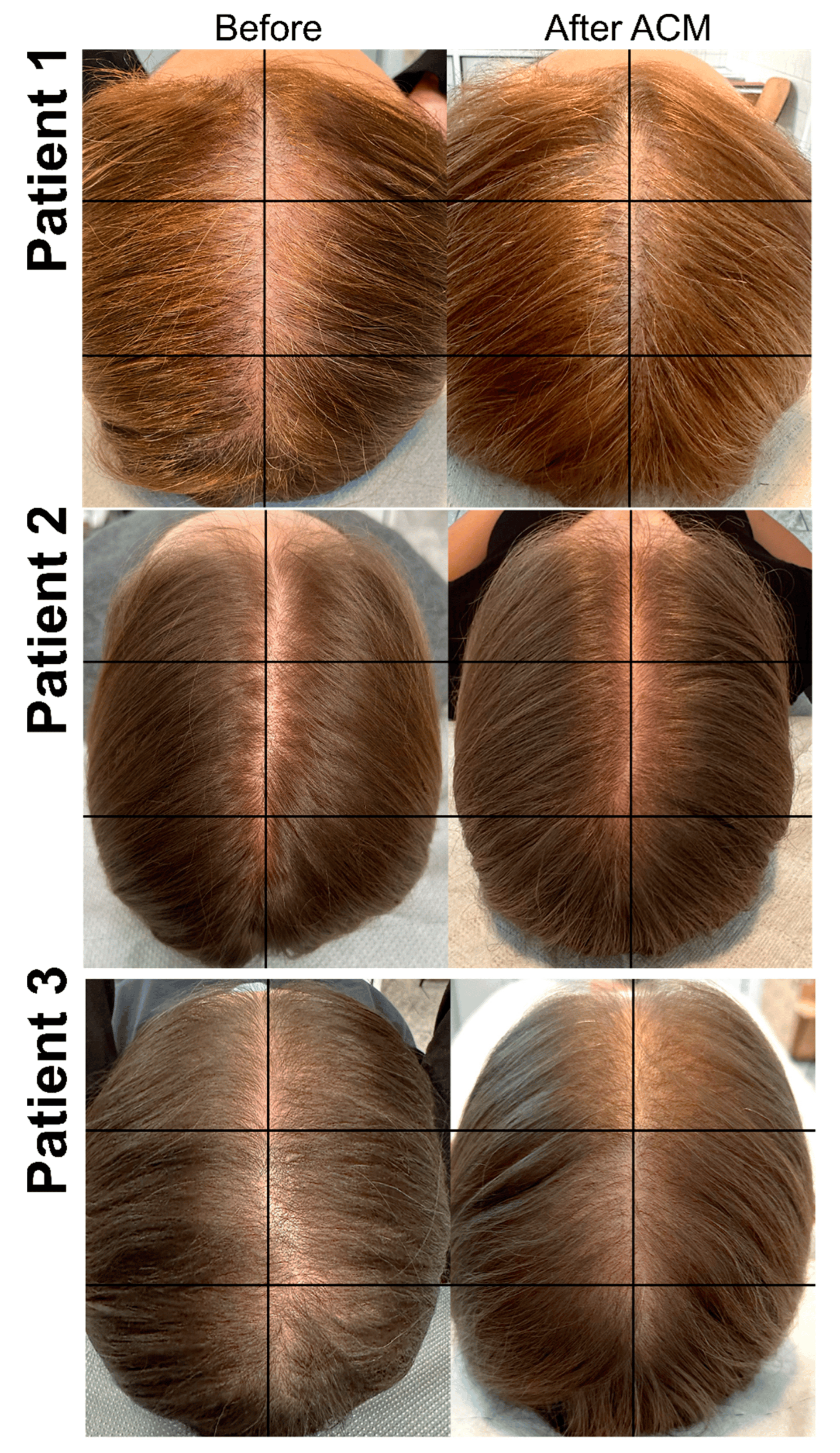 圖2:ACM治療前和治療后AGA患者樣本的照片。 圖2:ACM治療前和治療后AGA患者樣本的照片。