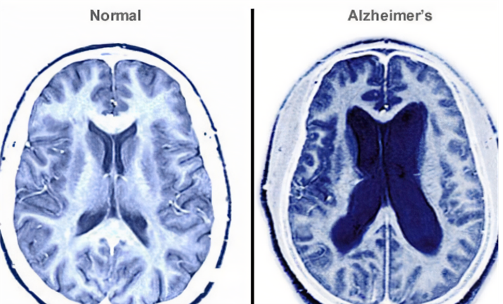 干細胞治療阿爾茲海默癥機制分2種途徑