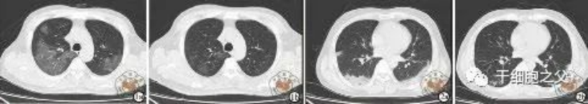細胞輸注后,炎癥指標改善,復查胸部CT提示雙肺病灶較前吸收,呼吸道癥狀改善,新型冠狀病毒核酸檢測連續2次陰性,治愈出院。 細胞輸注后,炎癥指標改善,復查胸部CT提示雙肺病灶較前吸收,呼吸道癥狀改善,新型冠狀病毒核酸檢測連續2次陰性,治愈出院。