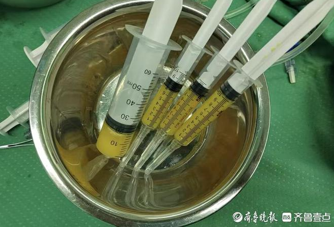 孫濤主任采用的自體脂肪微片段治療術(shù)，為她的治療帶來(lái)了新的轉(zhuǎn)機(jī)