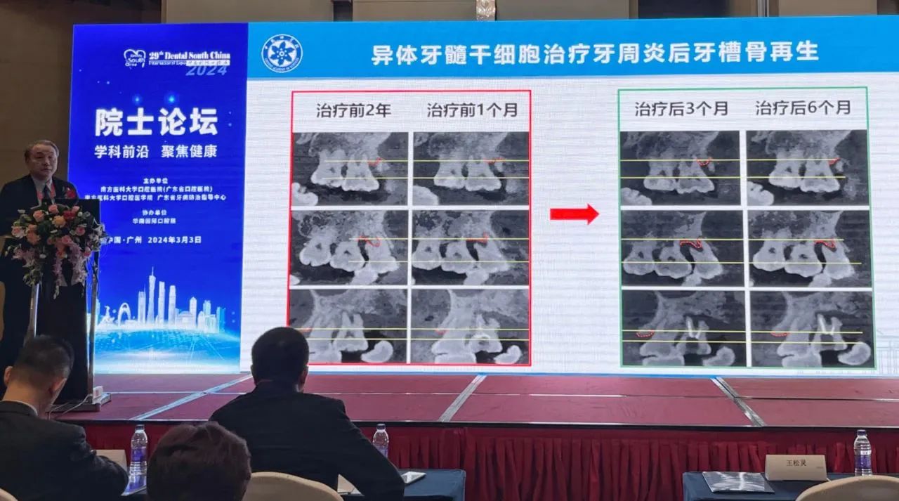 異體牙髓干細胞治療牙周炎后牙槽骨再生 異體牙髓干細胞治療牙周炎后牙槽骨再生