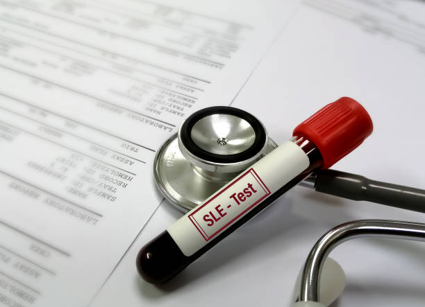 臍帶干細胞可以幫助狼瘡患者嗎？