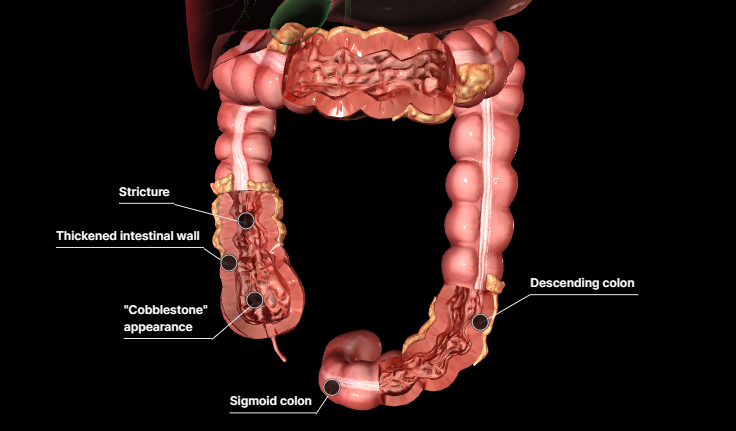 △克羅恩病3D圖示,來源:默沙東診療手冊 △克羅恩病3D圖示,來源:默沙東診療手冊
