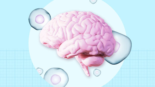 早期數據表明干細胞療法可以“重置帕金森病的時鐘”