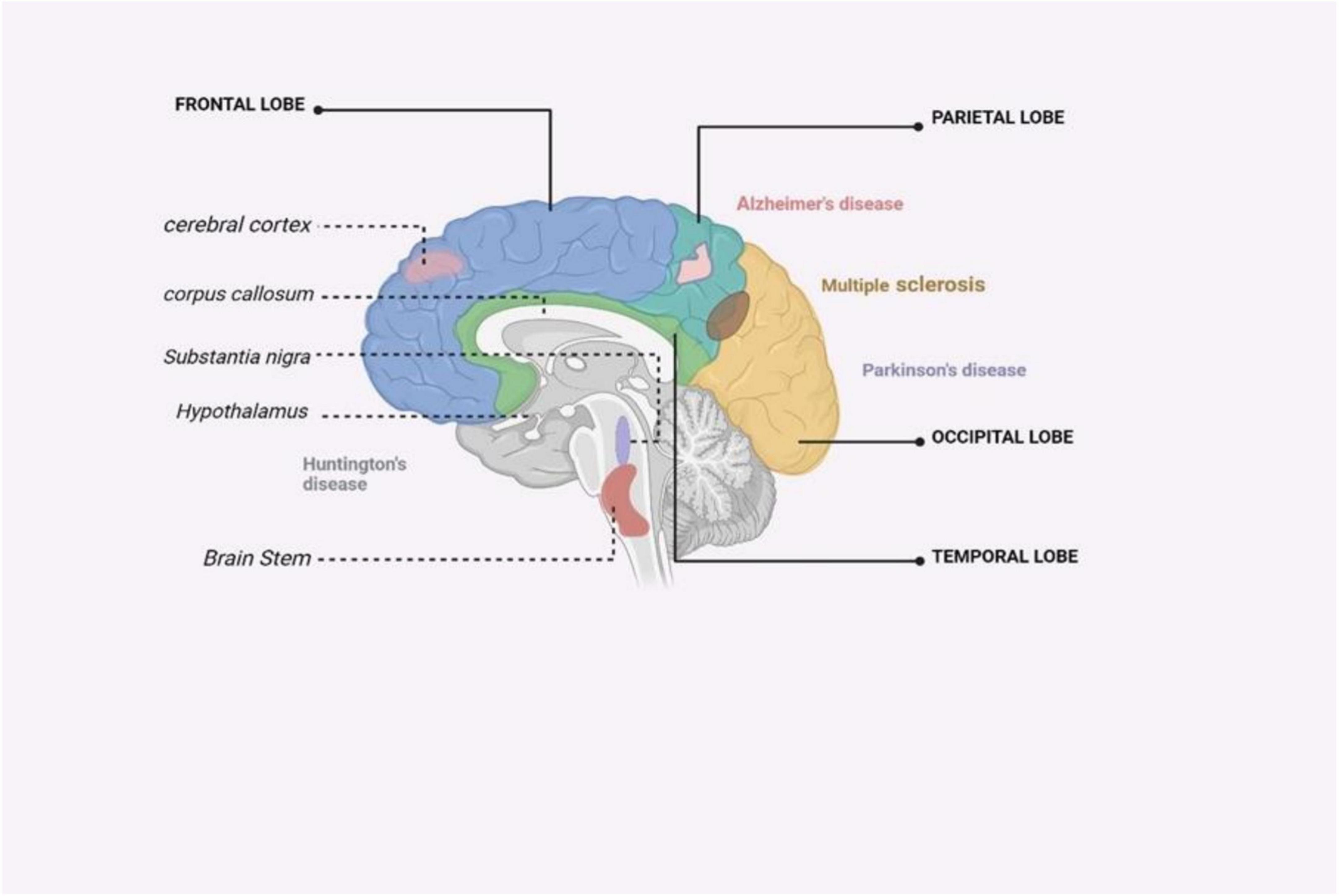 圖4：受主要神經退行性疾病影響的大腦區(qū)域的圖解摘要
