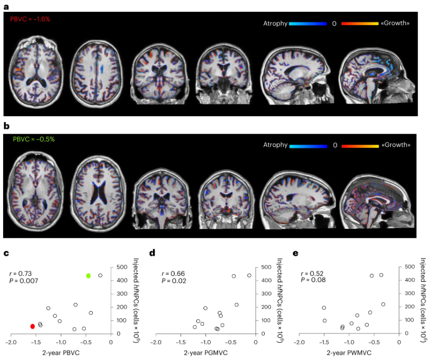 較低的腦萎縮與大量注射干細胞相關