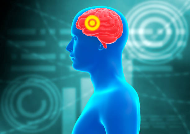 中風患者的康復策略有哪些？