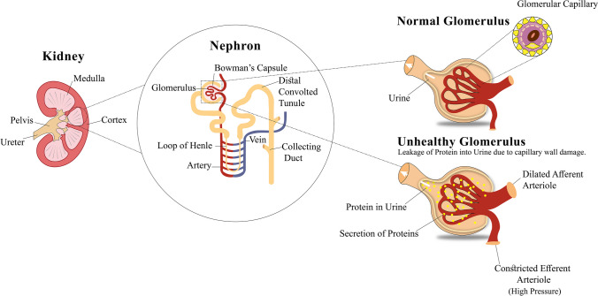 圖1:導致糖尿病腎病的原因,即糖尿病引起的腎臟疾病 圖1:導致糖尿病腎病的原因,即糖尿病引起的腎臟疾病