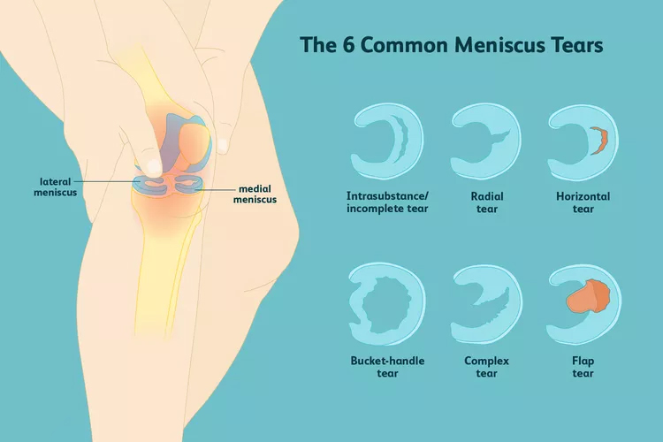 膝關節半月板損傷：你了解這六種撕裂類型嗎？