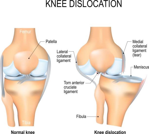 半月板撕裂后該如何恢復? 半月板撕裂后該如何恢復?