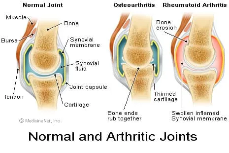 骨關節炎:你真的了解是什么導致你的關節痛嗎? 骨關節炎:你真的了解是什么導致你的關節痛嗎?