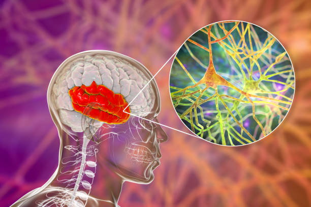 如何治療精神分裂癥? 如何治療精神分裂癥?