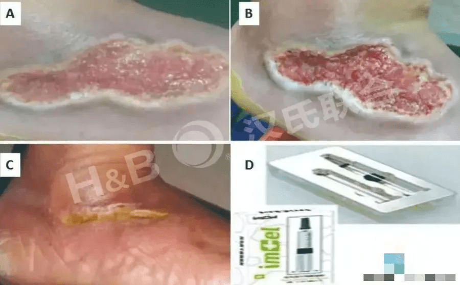 糖尿病足潰瘍患者使用胎盤衍生間充質干細胞水凝膠進行三周局部治療：病例報告。