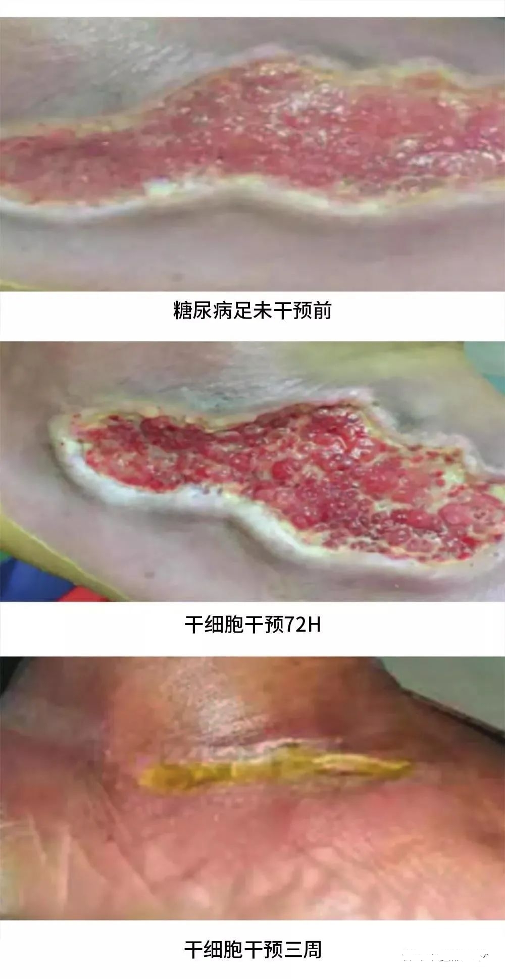 患者治療72小時(shí)化膿性分泌物和傷口大小明顯減少，3周后足部潰瘍幾乎愈合，足部行走功能也得到了恢復(fù)。
