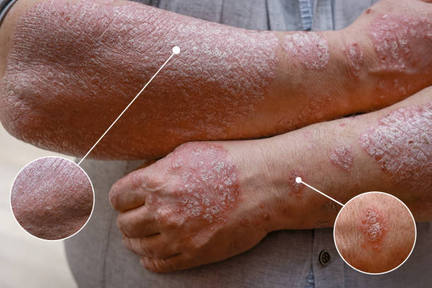 銀屑病治療新策略:干細胞治療銀屑病的臨床應用與效果評估 銀屑病治療新策略:干細胞治療銀屑病的臨床應用與效果評估