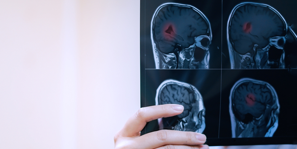 多發性硬化癥的干細胞療法:探索神經免疫學的新前沿 多發性硬化癥的干細胞療法:探索神經免疫學的新前沿