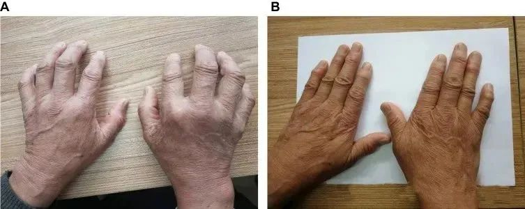 一名68歲男性被診斷患有類風濕性關節炎治療前后的對比