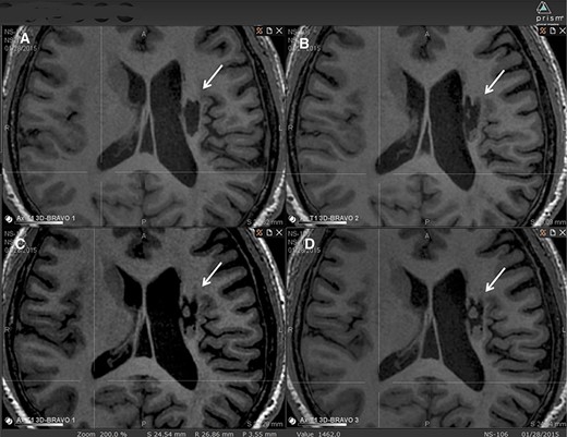 圖2:腔內組織生長的縱向MRI示例。 圖2:腔內組織生長的縱向MRI示例。